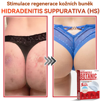 💖GFOUK® Mikrojehličková botanická náplast na odstranění bradavic