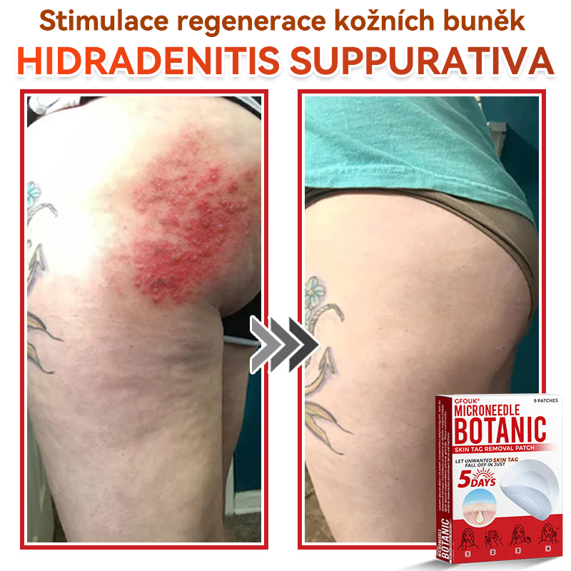 💖GFOUK® Mikrojehličková botanická náplast na odstranění bradavic