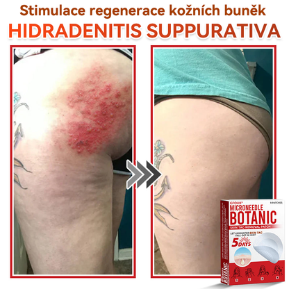 💖GFOUK® Mikrojehličková botanická náplast na odstranění bradavic