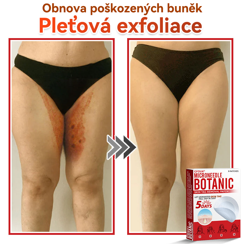 💖GFOUK® Mikrojehličková botanická náplast na odstranění bradavic