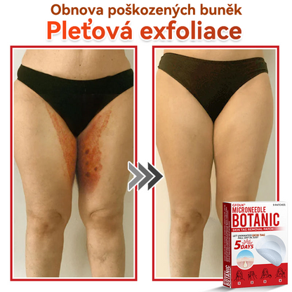 💖GFOUK® Mikrojehličková botanická náplast na odstranění bradavic