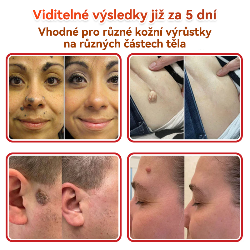 💖GFOUK® Mikrojehličková botanická náplast na odstranění bradavic