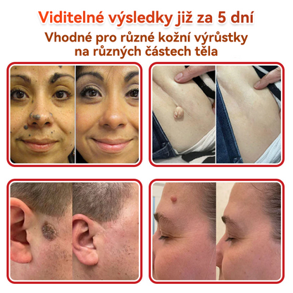 💖GFOUK® Mikrojehličková botanická náplast na odstranění bradavic