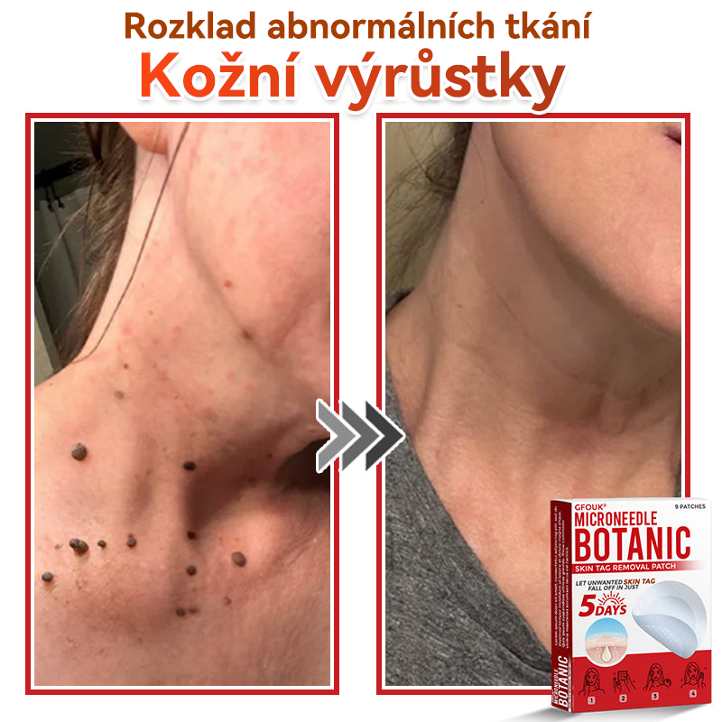 💖GFOUK® Mikrojehličková botanická náplast na odstranění bradavic