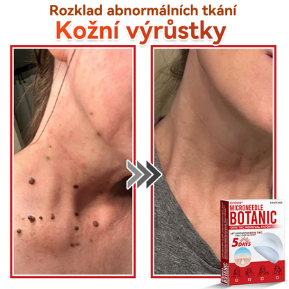 💖GFOUK® Mikrojehličková botanická náplast na odstranění bradavic