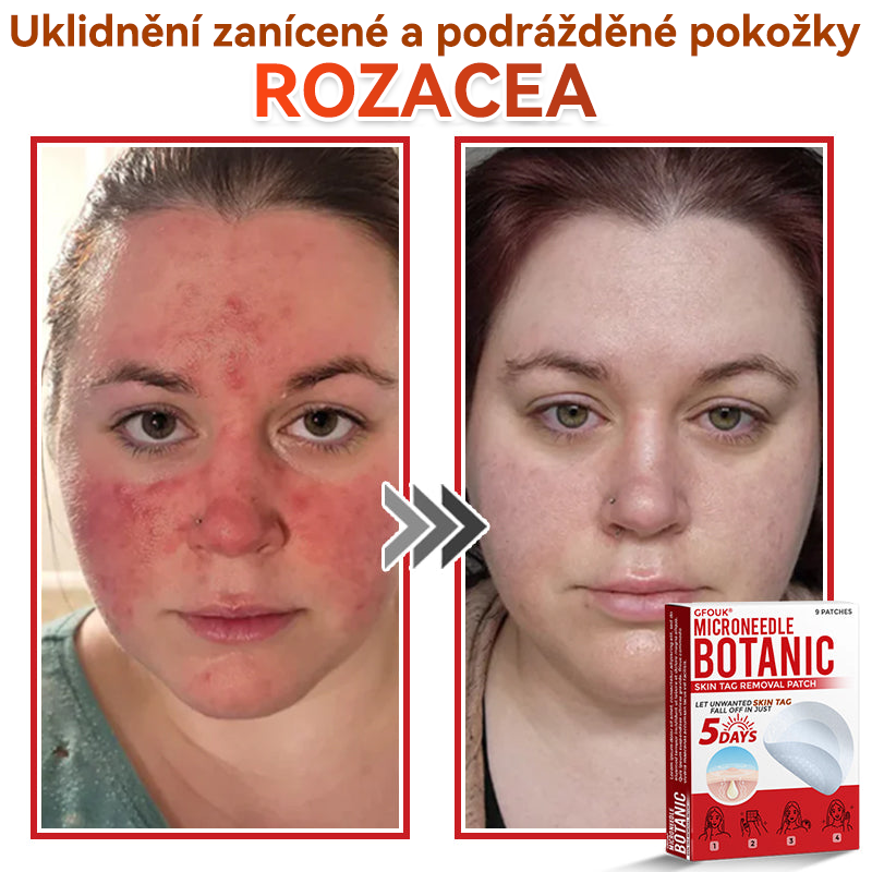 💖GFOUK® Mikrojehličková botanická náplast na odstranění bradavic
