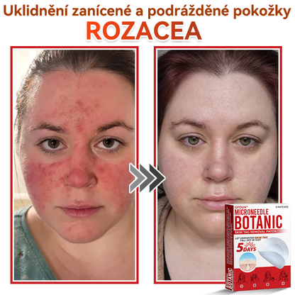 💖GFOUK® Mikrojehličková botanická náplast na odstranění bradavic