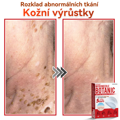 💖GFOUK® Mikrojehličková botanická náplast na odstranění bradavic