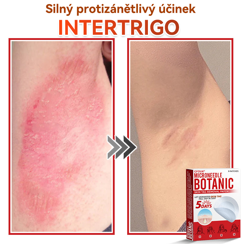 💖GFOUK® Mikrojehličková botanická náplast na odstranění bradavic